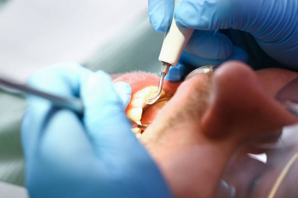 Best Emergency Wisdom Teeth Removal in Kane, PA