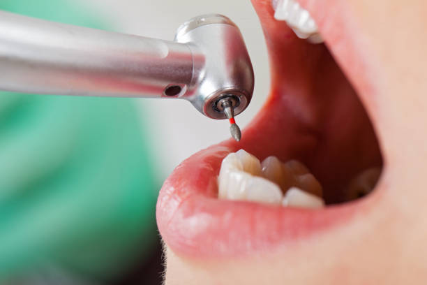 Best Emergency Tooth Extraction in Kane, PA